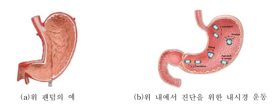 위 팬텀 및 진단의 예