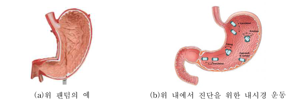 위 팬텀 및 진단의 예