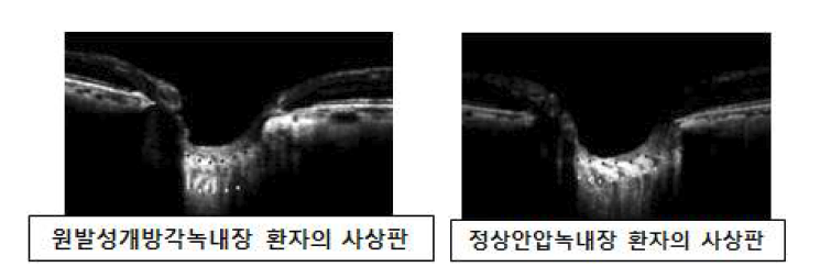 본 연구진은 정상안압녹내장 환자들의 사상판의 두께가 원발성개방각녹내장 환자들에 비해 얇다는 것은 보고하였다