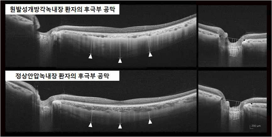 본 연구진은 정상안압녹내장 환자들의 후극부 공막의 두께가 원발성개방각녹내장 환자들에 비해 얇다는 것은 보고하였다