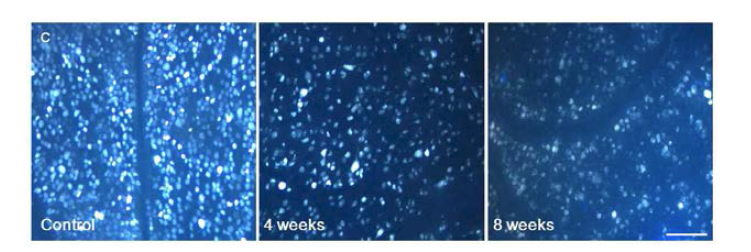 저자들의 연구 사진 : 녹내장 모델에서 stereotaxic dye injection을 통해 망막신경절세포를 retrograde labelling해보면 axoplasmic flow 차단에 의한 neurotrophic factor deprivation을 관찰할 수 있다