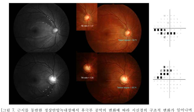 근시를 동반한 정상안압녹내장에서 후극부 공막의 변화에 따라 시신경의 구조적 변화가 일어나며