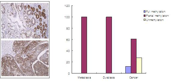 암환자 조직의 면역 염색을 통한 CA9 methylation과 gastric cancer progression의 상관관계