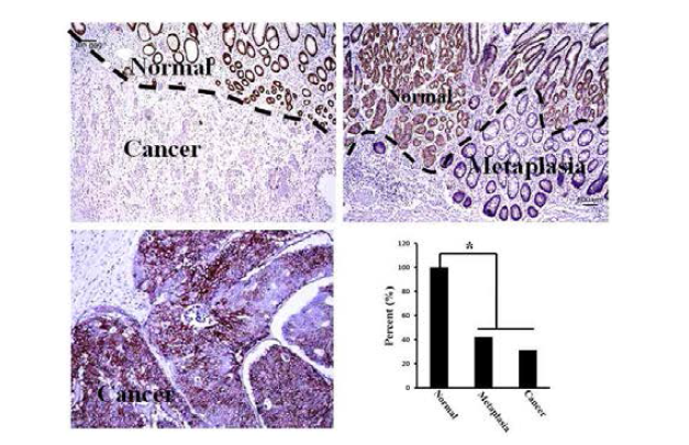 정상 위점막, 장상피화생 및 위암 조직에서의 CA9 단백질 발현