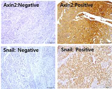 자궁경부암 조직에서 Axin2와 Snail의 발현을 확인