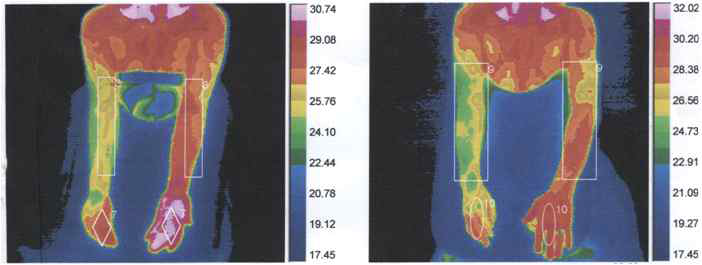 복합부위통증증후군 환자에서의 체열촬영 결과