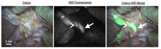 수술 중 내비게이션: 복강경 수술 중 형광 광학 영상을 이용해 표적(암) 조 직(초록색)과 정상 조직을 확연하게 구분할 수 있음