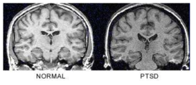 정상인과 PTSD 환자 간의 뇌 회백질 volume 차이
