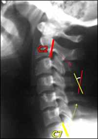 단순방사선검사를 통한 경추 전만 평가(Posterior tangent method)