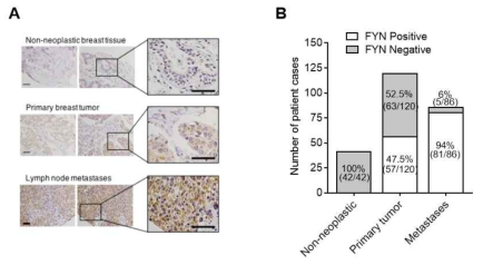 전이된 유방암 환자 조직에서 FYN의 높은 발현율
