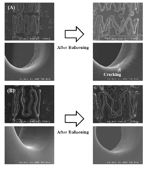 스텐트 ballooning 전 (A), 후 (B) 비교