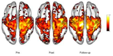 뇌졸중환자에서 복합 비침습 뇌자극 후 운동신경망의 변화 (그림에서 오른쪽이 병변측)