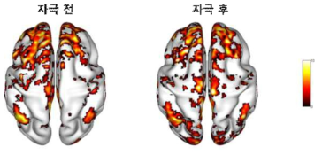 비침습 뇌자극 전과 후 기능적 자기공명영상에서 인지신경망 가소성 분석