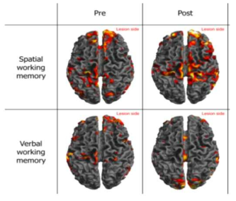 누적 복합 비침습 뇌자극 전과 후 공간 및 언어 작업기억과제 수행시 인지신경망의 변화