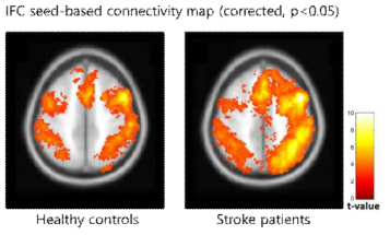 정상 성인(왼쪽) 및 뇌졸중 환자 발병 당시(오른쪽)에서 전하두엽 영역(IFG)과의 연결성 비교