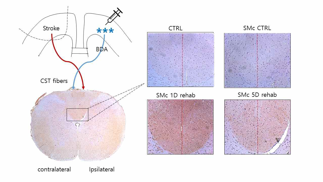 SMc stroke, 1D, 5D 재활 치료 시작 그룹에서 피질척수로 가소성의 비교