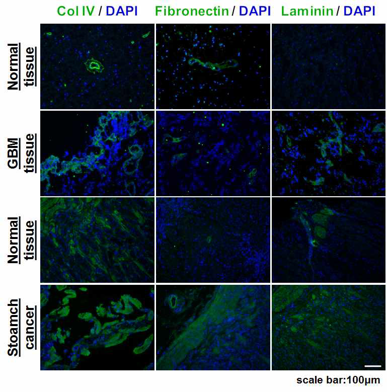 Immunohistochemistry를 통한 환자채취 종양 내 ECM 변화 분석