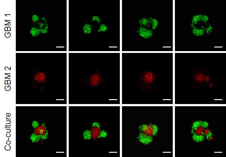 두 종의 GBM을 활용한 종양 organoid에서의 종양 내 공간 비균질성 (intra-tumor heterogeneity).