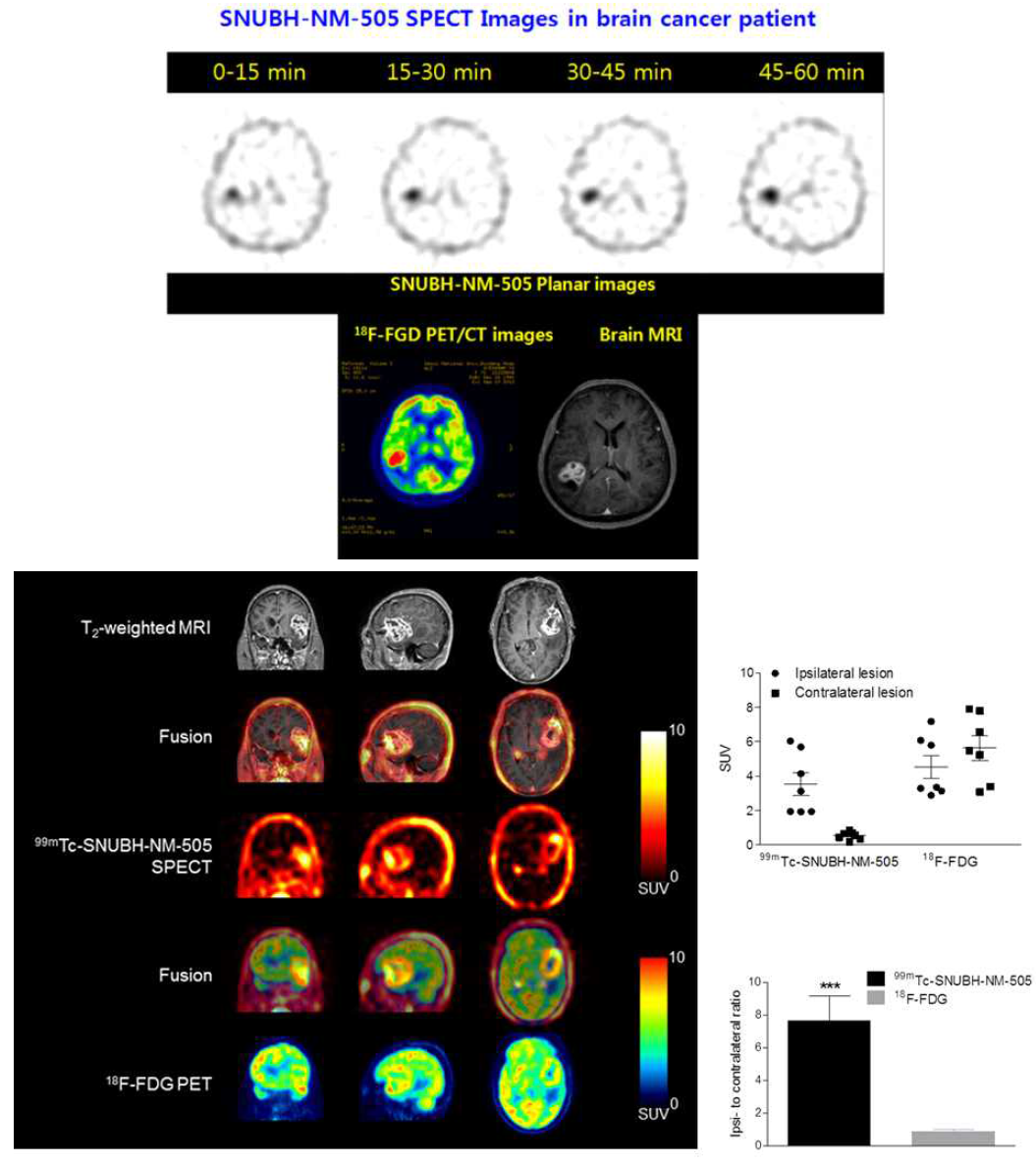 Tc-99m-SNUBH-NM-505의 임상시험 결과(뇌암 환자군)