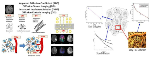 확산강조영상을 병리생태학적 기전에 따라 정밀하게 분석한 지표를 산출