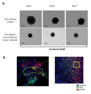 간암세포주와 간암환자유래 일차간암세포를 이용하여 형성한 구상체에서의 약물 민감성 비교(A) 및 그림 2-A의 환자 조직의 구성 요소를 형광면역 염색(CD45, EpCAM)으로 확인함.