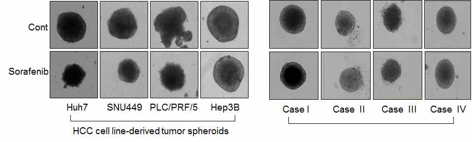 간암세포주(A)와 간암 환자유래 간암세포(B)를 이용한 종양 구상체의 소라페닙에 대한 민감성 비교 분석.