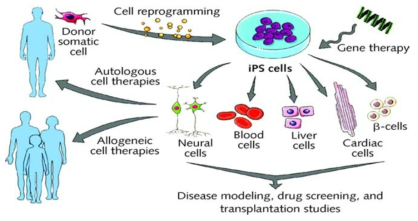 체세포에 유전자를 도입한 역분화줄기세포를 이용한 세포치료제 개발