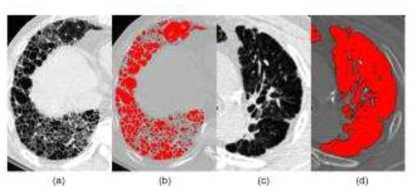 예비연구를 통해 검토된 COPD severe case에 폐실질 분할 기술을 적용한 사례(CT 영상에서 –400 HU이하 영역에 대해 분할 기술을 적용함(b), (d))