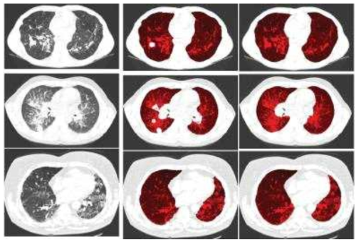 유럽의 한 대학에서 개발한 폐실질 분할 사례; (좌로부터) 병변이 있는 폐실질과 이를 개선하여 병변 유무와 상관없이 외곽선을 정확히 보정해주는 결과