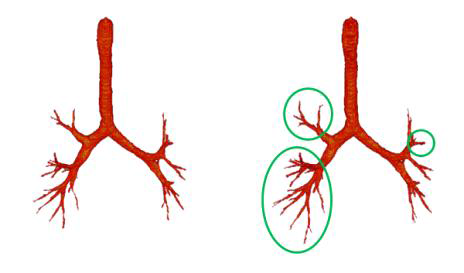 AD(좌)와 TV(우) 잡음 감쇄 기술 적용을 통한 기관지 추출 결과 비교; 기관지 영역성장법 적용에 앞서 AD과정보다 TVM 과정이 미세기관지를 더 많이 찾는 것을 직관적으로 확인; 저선량 CT에서 AD에 비해 TVM 기법이 경계정보를 더욱 잘 보존하며 잡음을 제거함.