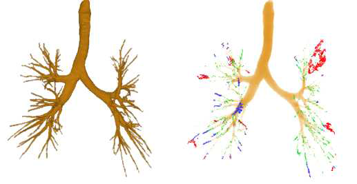 1차년도 연구를 통해 개발된 고성능 기관지 추출 결과(좌); (우)황색: 고전적인 영역 성장법의 결과; 녹색: Hessian 형태 분석을 통해 추출된 영역; 파란색: 벡터 영역 성장법을 통해 추출된 영역; 빨간색: 저선량 CT 잡음으로 인한 FP 영역.