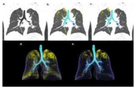 폐실질 내 이상 부위를 탐지하여 정량화하는 CT 폐밀도 측정 연구 결과