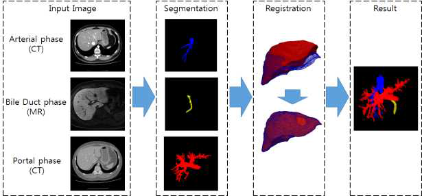 각기 다른 영상에서 추출한 혈관을 강체정합(rigid registration) 기법을 적용하여 정합한 간혈관 결과