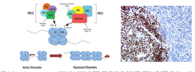 Polycomb repressor complex 1 (PRC1) 와 2 (PRC2) 의 구조와 역할 (좌) EZH2가 유방암 환자 세포에서 높게 발현됨 (우) (Novus, Co) Immunohistochemistry staining for EZH2 (brown) and nucleus (blue)