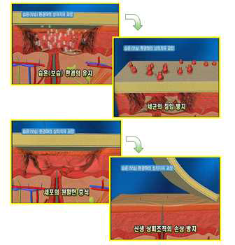 습윤드레싱제를 이용한 상처 치유 장점