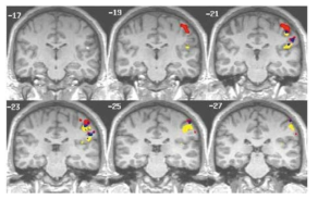 Flutter(35Hz) 와 vibration(150Hz) 자극에 반응하는 somatosensory cortex의 활성화 및 fMRI mapping (Red: 35Hz, yellow: 150Hz, blue: both, 1.5T MRI, human subjects)