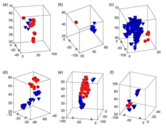 MNI coordinates 공간에서 서로 분리되어 그룹을 형성하는 positively correlated voxels(○)과 negatively correlated voxels(▽)의 분포 (A: anterior, P: posterior)