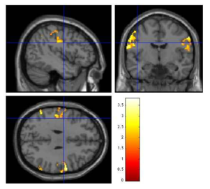 자극물과 Sham 자극물의 onset 시점에서 비교한 Somatosensory 영역의 활성화 (Sub 12. x=-44, y=-7, z=30)