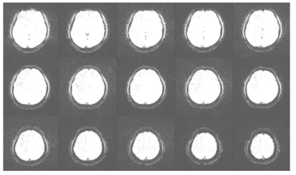 Human brain 영상에서 노이즈의 영향을 연속적으로 받은 모습 바둑판식으로 노이즈의 영향이 미침)