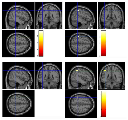 Interpolation을 통해 뇌 영상 데이터에서 노이즈를 제거하기 전(좌)과 후(우)