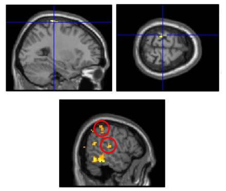 Premotor 영역이 활성화된 2번 피험자(위)와 Parietal lobe의 여러 부분에 걸쳐서 활성화를 보인 7번 피험자(아래)