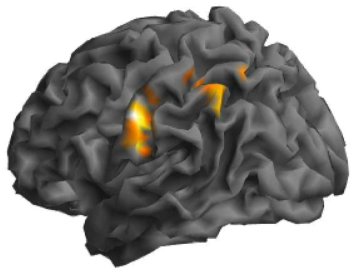 Von frey hair 자극에 대한 반응으로 활성화되는 somatosensory 영역과 parietal 영역