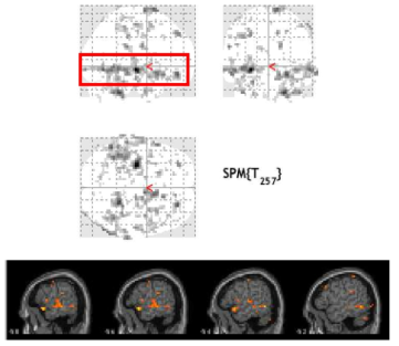 비정상적인 활성화 패턴을 보여주는 Block 실험 디자인의 fMRI 분석 결과