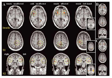 압력 자극과 두 가지 다른 온도 자극(32℃ 및 20℃)에 대한 뇌의 활성 영역 (S1: primary somatosensory cortex, S2: secondary somatosensory cortex)