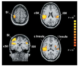 4Hz의 전기 신호를 통한 전기 자극에 반응하는 뇌의 활성 영역 (SI: primary somatosensory cortex, SII:secondary somatosensory cortex)