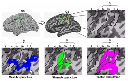 실제 한의학용 침, 모조 한의학용 침 및 플라스틱 고리를 사용한 가벼운 압력의 촉각 자극에 반응하는 뇌의 활성 영역 및 활성 영역의 크기 (SI: primary somatosensory area, SII: secondary somatosensory area, PP: posterior parietal areas)