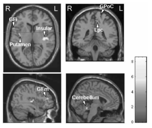 41℃의 온도 자극(warm)에 반응하는 뇌의 활성 영역 (insular, putamen, inferior frontal gyrus, middle frontal gyrus, postcentral gyrus, paracentral lobule 및 cerebellum)