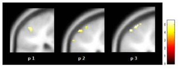 중지(d3)의 somatosensory cortex 영역 활성화