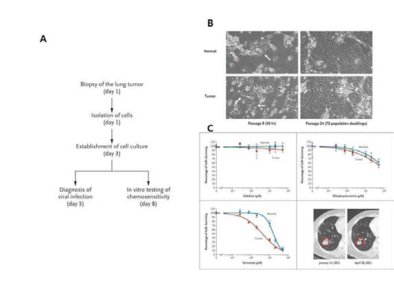 Conditionally reprogrammed cell culutre (CRC) 법을 이용한 respiratory papillomatosis 환자의 맞춤형 치료 성공 사례.