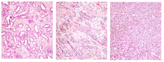 유방암 조직의 histologic grade (modified Bloom&Richardson)